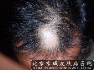 北京植发费用多少钱