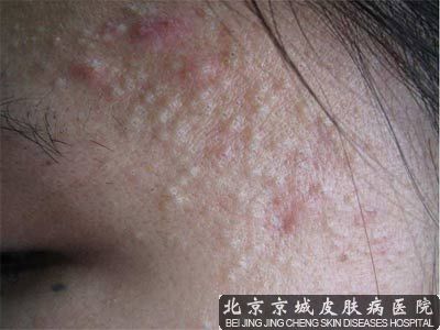 青春痘的症状是哪些