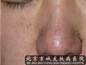 北京治疗酒糟鼻的医院哪家比较好
