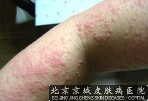 怎么预防荨麻疹复发