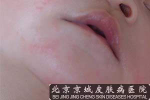 女性夏季患皮炎怎么办