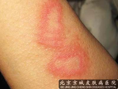 皮炎的危害有哪些