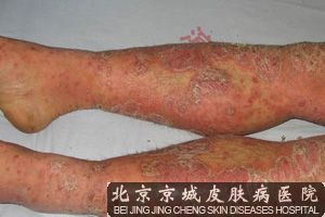 患上牛皮癣的原因是什么