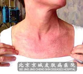 红斑狼疮会遗传吗