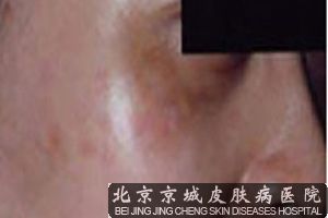 预防黄褐斑的方法有哪些