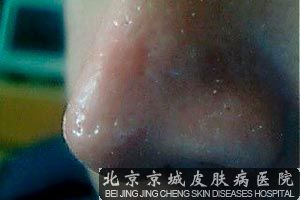 酒糟鼻该怎样治疗