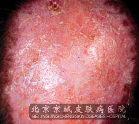 红斑狼疮常见的治疗方法有哪些