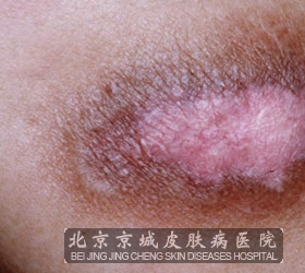 得了红斑狼疮可以生孩子吗