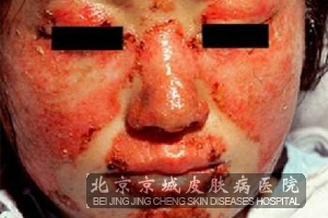 红斑狼疮可以 吗