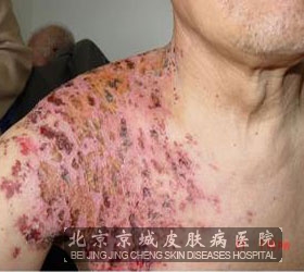 红斑狼疮能生小孩吗