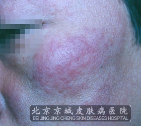 红斑狼疮的症状