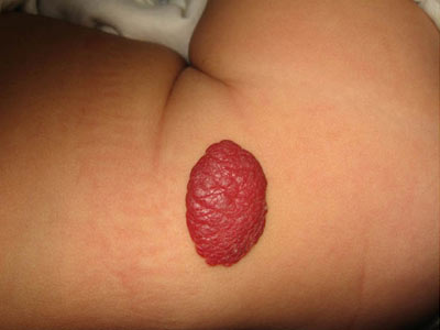 血管瘤图片