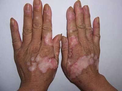 狼疮性红斑症状