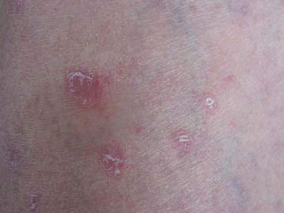 狼疮性红斑症状