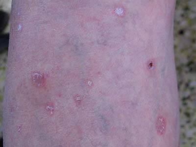 狼疮性红斑症状