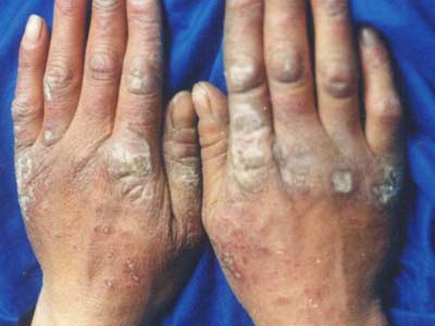 狼疮性红斑症状