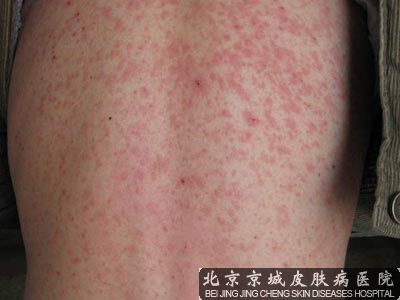 药疹应该怎么办