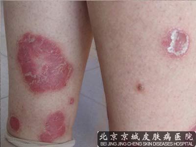 北京治疗银屑病的医院