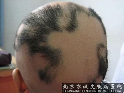斑秃*佳治疗方法