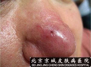 酒糟鼻中医治疗