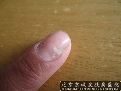 灰指甲治疗的误区