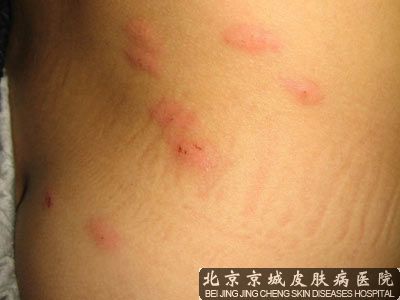 丘疹性荨麻疹的治疗