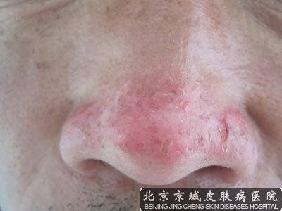 治疗酒糟鼻哪个医院好