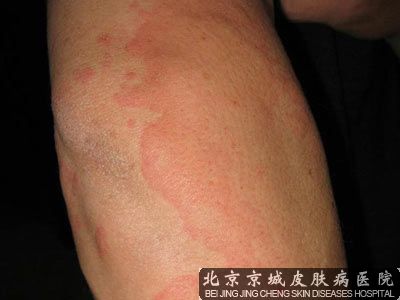 中西医结合治疗荨麻疹