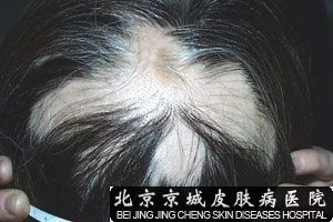预防脱发的方法