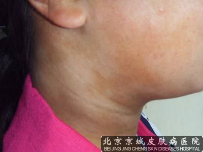 花班癣较佳治疗方法