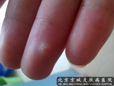 手上长肉刺怎么治