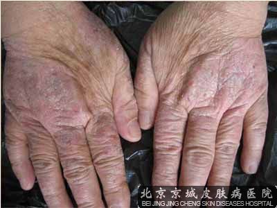 手上起湿疹怎么办