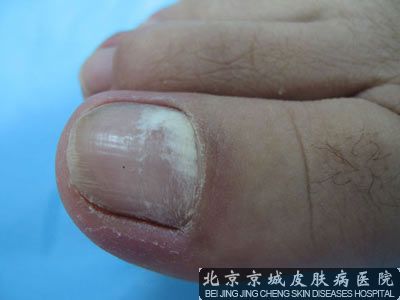 指甲有白斑怎么回事