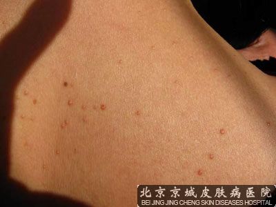 我脖子上长了好多丝状疣怎么治