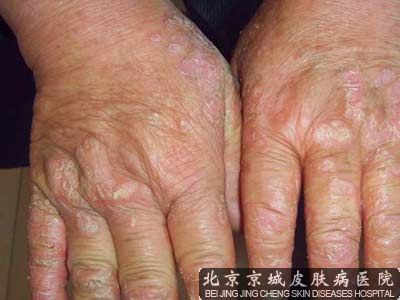 手脱皮是怎么回事