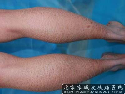 鱼鳞皮肤怎么治疗