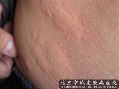 胆碱能性皮麻疹