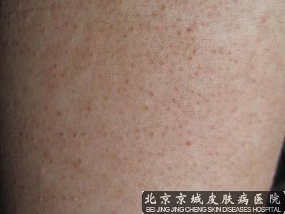 激光治疗鸡皮肤