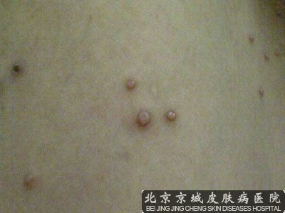 哪个医院治疗病毒性软疣比较好