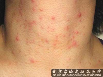 螨虫皮肤能基本 吗