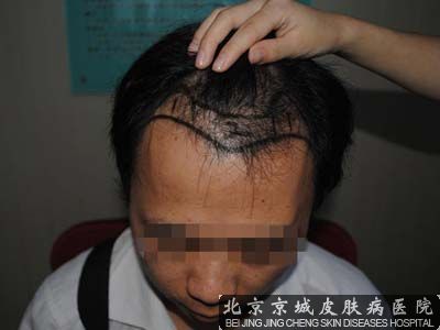 洗头发掉头发怎么办