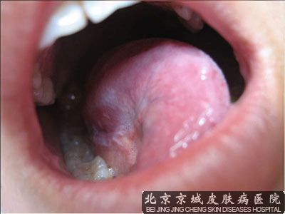 患上天疱疮怎么治疗