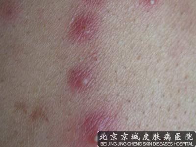 颈部毛囊炎