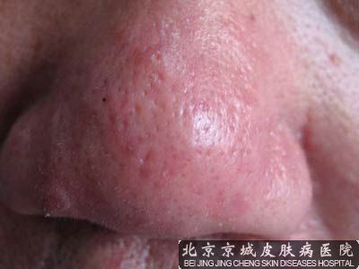皮肤病酒渣鼻的治疗方法