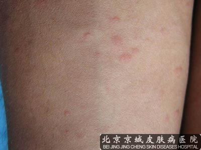 秋季荀麻疹怎么治疗