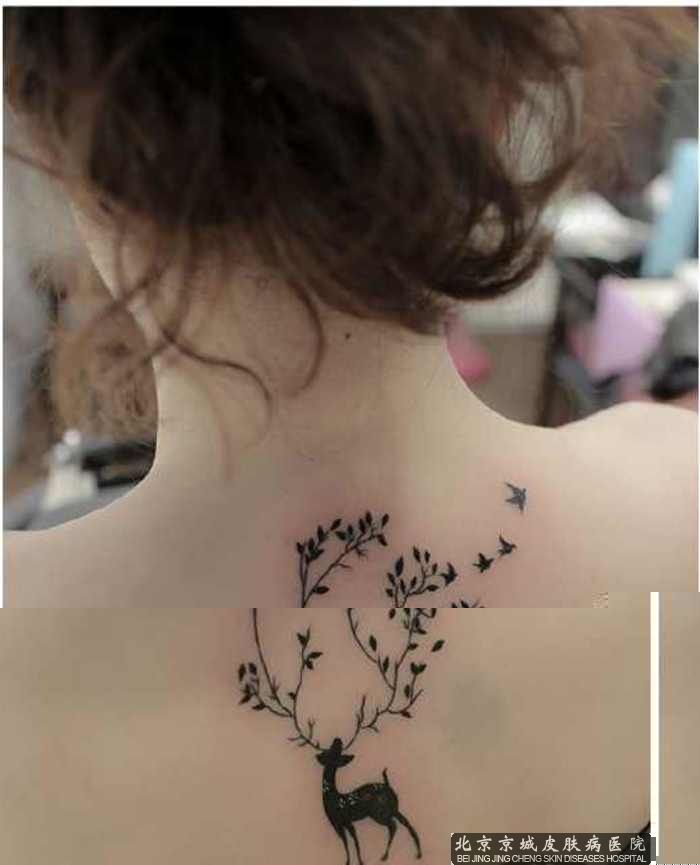 北京那个医院洗刺青