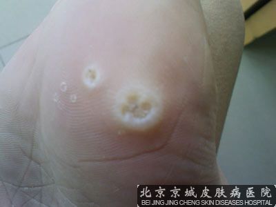 北京哪家医院看跖疣比较好