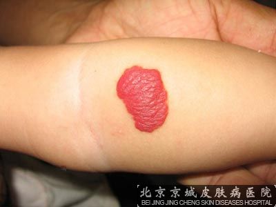草莓状血管瘤的症状特点