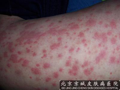 怎样才的 过敏性紫癜