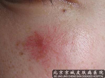血管瘤治 果怎样呢